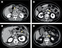 Stanford cancer center palo alto. Deep Learning To Distinguish Pancreatic Cancer Tissue From Non Cancerous Pancreatic Tissue A Retrospective Study With Cross Racial External Validation The Lancet Digital Health