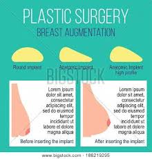 Plastic Breast Vector Photo Free Trial Bigstock