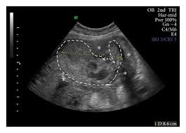 Image result for Retained Placenta