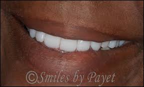 Removable Dentures Implant Overdentures Charlotte Dentist