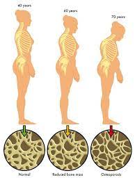 Symptoms Of Osteoporosis