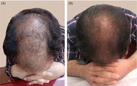 Microneedling can cause skin irritation, bruises, etc. Microneedling In Androgenetic Alopecia Comparing Two Different Depths Of Microneedles Faghihi 2021 Journal Of Cosmetic Dermatology Wiley Online Library