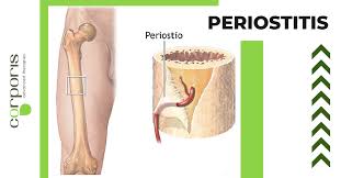 Image result for periostitis