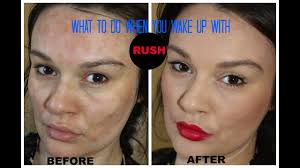 Medicinenet does not provide medical advice, diagnosis or treatment. What To Do If You Have Rash On Your Face Contact Dermatitis Youtube