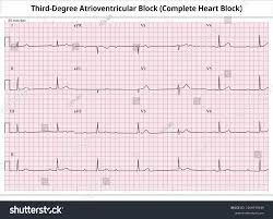 Image result for Atrioventricular Block