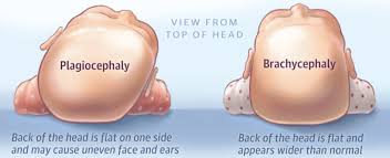 Image result for Positional Head Deformity