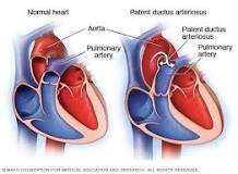 Image result for what is patent ductus arteriosus treatment