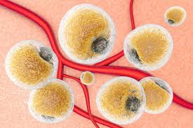 Breast cancer is a disease in which certain cells in the breast become abnormal and multiply uncontrollably to form a tumor. Breast Swelling And Inflammatory Breast Cancer News