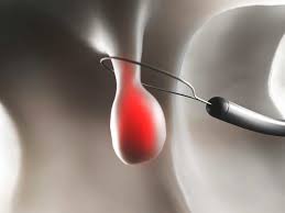 Pected colonic disease is often not practical and some. Gallbladder Polyps Symptoms Treatment And Home Remedies