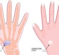 Ganglion Cyst of the Wrist: How Do I Know if I Have One?