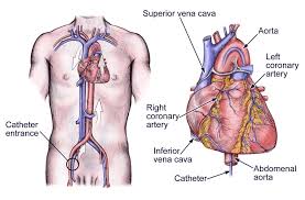 Cardiac Catheterization Left Heart Cardiac Catheterization Cardiac Cardiac Nursing