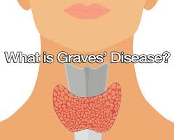 Graves' disease, also known as toxic diffuse goiter, is an autoimmune disease that affects the thyroid. What Is Graves Disease Thyroid Advisor