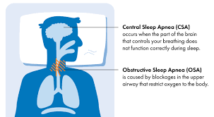 Image result for Sleep Apnea