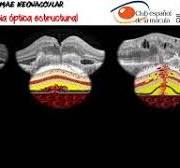 IMAGEN MULTIMODAL EN DMAE NEOVASCULAR