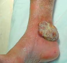 We encourage you to make connections; Merkel Cell Carcinoma An Unusual Indication For Isolated Limb Perfusion