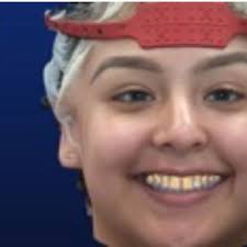 Digital workflow for an esthetic rehabilitation using a facial and  intraoral scanner and an additive manufactured silicone index: A dental  technique