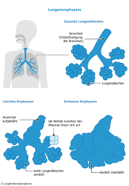 Erwachsene mit copd nehmen zur gilt als sicher und gut verträglich. Lungenemphysem Symptome Formen Und