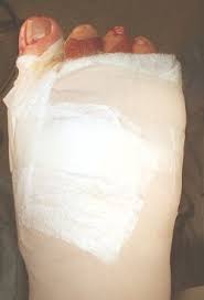 Bunion Surgery Recovery What To Expect After Bunion Surgery Bunion Surgery Surgery Recovery Bunion