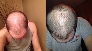 Users can submit their questions, which the site guarantees to have answered by a specialist within 24 hours. All The Cool Kids Are Using Ru58841 For Hair Loss Research Should You