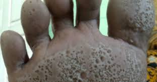 Image result for Pitting nails feet