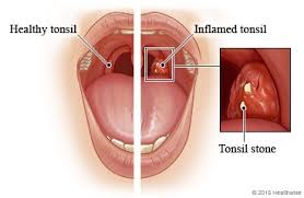 Before even giving a nod to a serious relationship, it would be wise to analyze whether the thing you are getting into is worthwhile. What Are Tonsils Stone Treatment Symptoms And Home Remedies About It Healthy Magazine