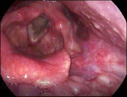 Image result for Reflux Laryngitis