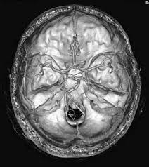 No es infarto masivo no hay procesos reparativos autólisis intravitam. Diagnostico De Muerte Encefalica Mediante Tomografia Computarizada Multicorte Angio Tc Y Perfusion Cerebral Medicina Intensiva