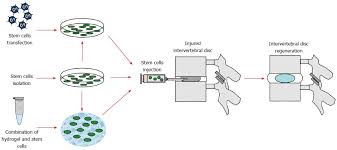 stem cells sources for intervertebral disc regeneration