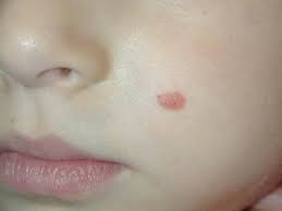 When a child gets melanoma, sun exposure is usually not the cause. Skin Cancer In Children Pictures 5 Photos Images Illnessee Com