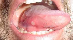 How to treat canker sores (home remedies). Canker Sore Vs Cold Sore What S The Difference