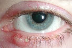 White Bump On Eyelid White Bump On Eyelid Skin Bumps Bumps Under Eyes