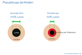 Pseudokrupp zählt zu den verhältnismäßig wenigen krankheiten, von denen hauptsächlich kinder und säuglinge betroffen sind. Pseudokrupp Kindernotfall Bonn Erste Hilfe Am Kind