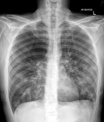 Image result for Emphysema