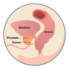 Eating a healthy diet can also help in maintaining energy, strength and quality of life as you go through and recover following treatment. How Does Spaceoar Hydrogel Work Spaceoar Gel Radiation