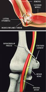 Image result for Epicondyle Injection