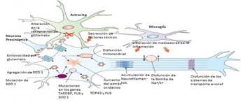Palabras clave esclerosis lateral amiotrófica, enfermedad de neurona motora, enfermedad neurológica. Evaluacion Neurofisiologica De La Afectacion De Motoneurona Superior Y Del Tratamiento Rehabilitador En La Evolucion De