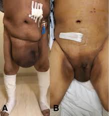 Image result for Inguinal hernia man