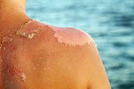 Do not exfoliate or peel away loose skin once it's started, as this can cause infection. Sunburn Peeling Why Sunburned Skin Peels How To Stop It