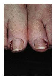 Image result for Paronychia feet