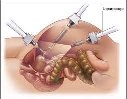 LOW COST Laparoscopic Gynecologic Surgery in India | BEST Hospital &  Surgeons For Laparoscopic Surgery