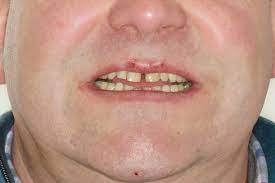 Braccio a 5 elementi fino a 40,5m di lunghezza, estensibili di altri 17,5m grazie alla prolunga telescopica. Korperliche Zahnbewegungen Und Transversale Korrekturen Teil 2 Zwp Online Das Nachrichtenportal Fur Die Dentalbranche
