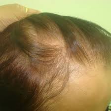 Consequently, the hair becomes thinner and delicate, and the cycles growing are shortened. Pdf Role Of Non Androgenic Factors In Hair Loss And Hair Regrowth Review Article