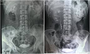 Image result for Genitourinary Tuberculosis