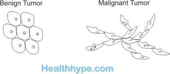 Malignant tumors contain cells that are cancerous, growing out of … What Is Cancer Development Growth And Spread Of Malignancy Healthhype Com