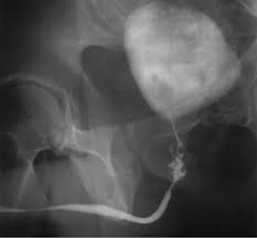 Image result for Retrograde Urethrogram