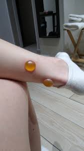 These blisters I got from a mosquito bite : rAbsoluteUnits