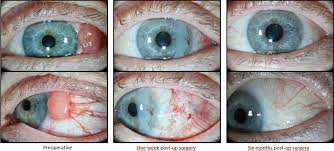 Image result for conjunctival melanoma