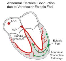 Focus, focus, or foci may refer to: Cv Physiology Ectopic Foci