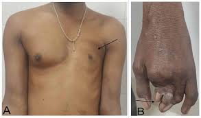 In some cases, surgery may also be performed to help correct skeletal abnormalities affecting other areas of the body such as the hands. Poland Syndrome Breast