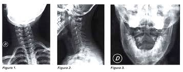 Maybe you would like to learn more about one of these? Dolor Cervical